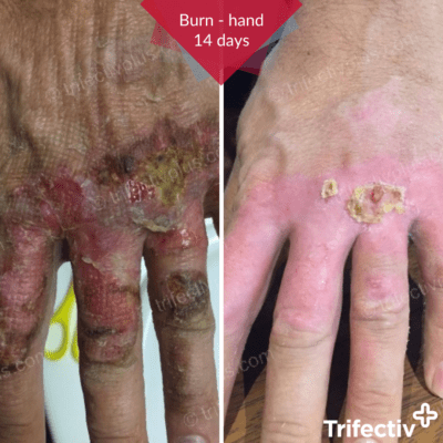 Burn on hand resolved after 2 weeks