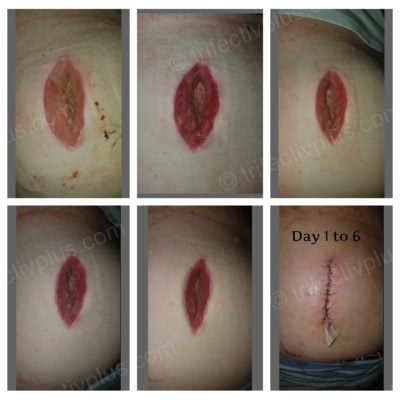 Septic puncture wound resolved in 6 days