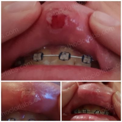 Mouth ulcer from braces healed