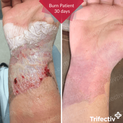 Burnt wrist resolved in 30 days with Trifectiv Plus